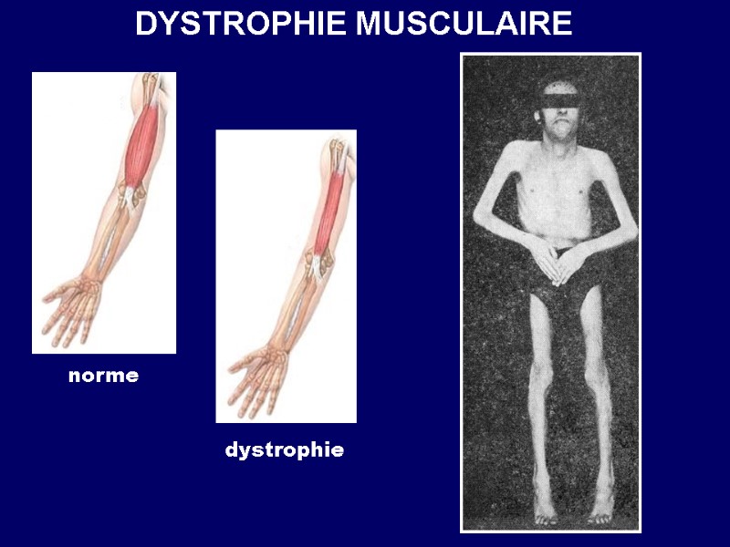DYSTROPHIE MUSCULAIRE norme dystrophie